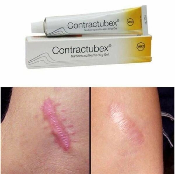 Gel Làm Mờ Sẹo Điều Trị Sẹo Lồi Contractubex Của Đức -Tuýp 30g - Image 2